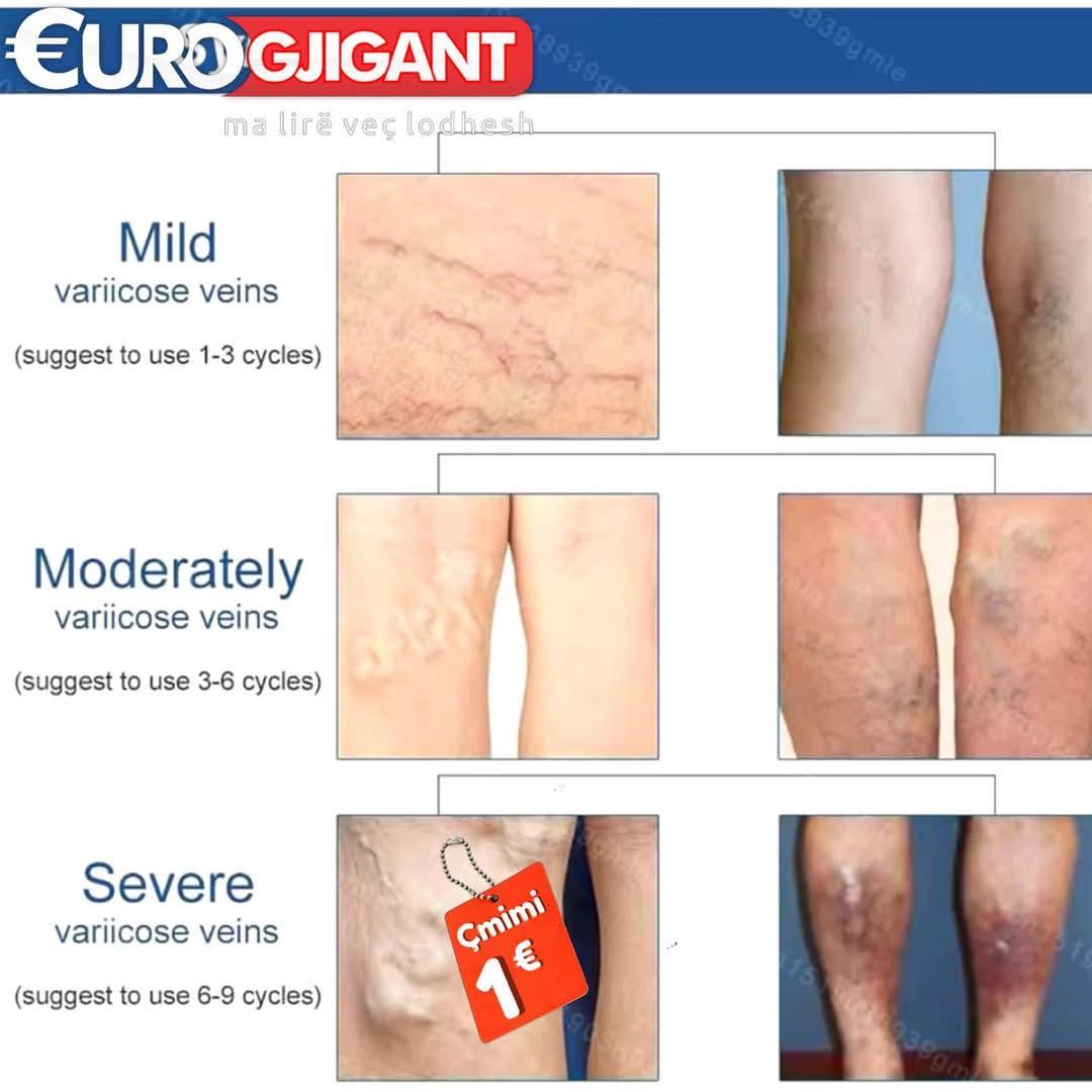 Clinically-Proven Varicose Veins Patch - 2 Pcs for Health and Wellness